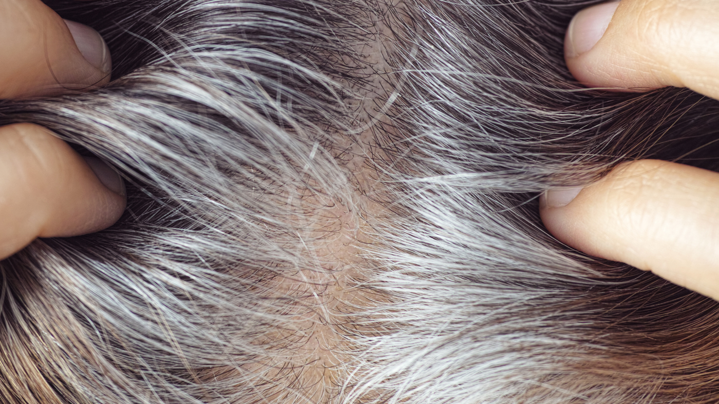 Going Grey Early? Understand the common causes, deficiencies and nutrients
